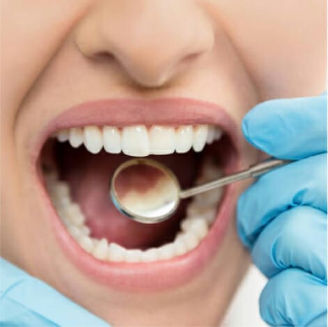 A dentist checking such as a dental crown or filling, onto a patient's tooth during a dental procedure.