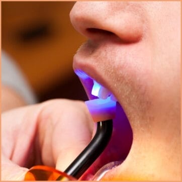 A close-up of a person's teeth after undergoing dental bonding.