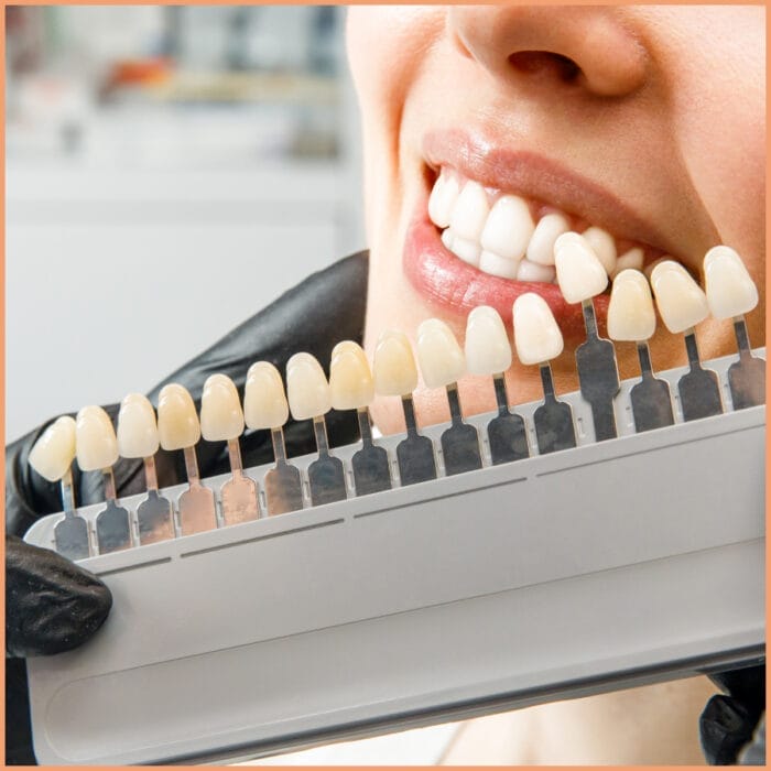 A person smiling confidently, showcasing their bright, even teeth enhanced with porcelain veneers. The close-up view highlights the natural-looking, perfectly aligned veneers that contribute to their beautiful smile.