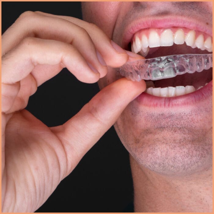 A close-up of a person wearing Invisalign aligners. The clear aligners are barely noticeable, fitting snugly over the teeth and illustrating the subtlety and effectiveness of this orthodontic treatment.