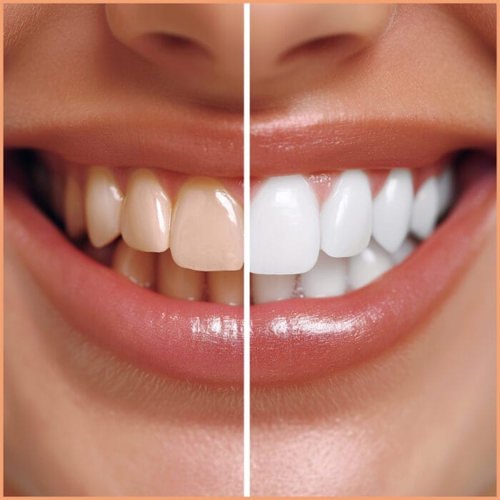 A side-by-side comparison of teeth before and after a whitening treatment. The "before" image shows teeth with noticeable stains and discoloration, while the "after" image features significantly brighter and whiter teeth, highlighting the dramatic improvement achieved through the whitening process.