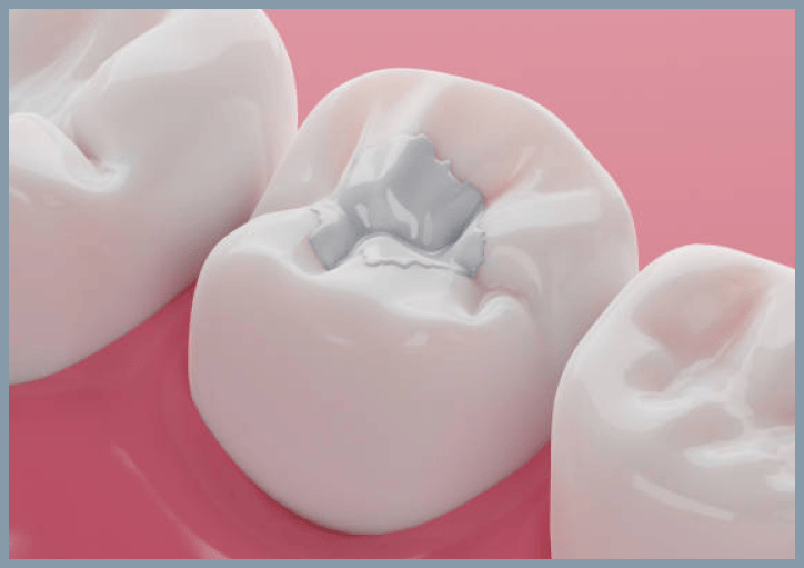 3D teeth dental sealant