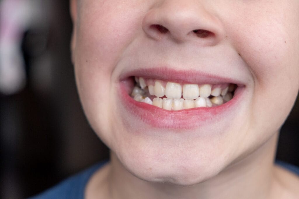 Child's crooked teeth. Young man showing crooked growing teeth. The child needs to go to the dentist to install braces.