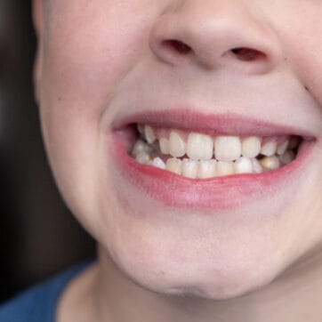 Child's crooked teeth. Young man showing crooked growing teeth. The child needs to go to the dentist to install braces.